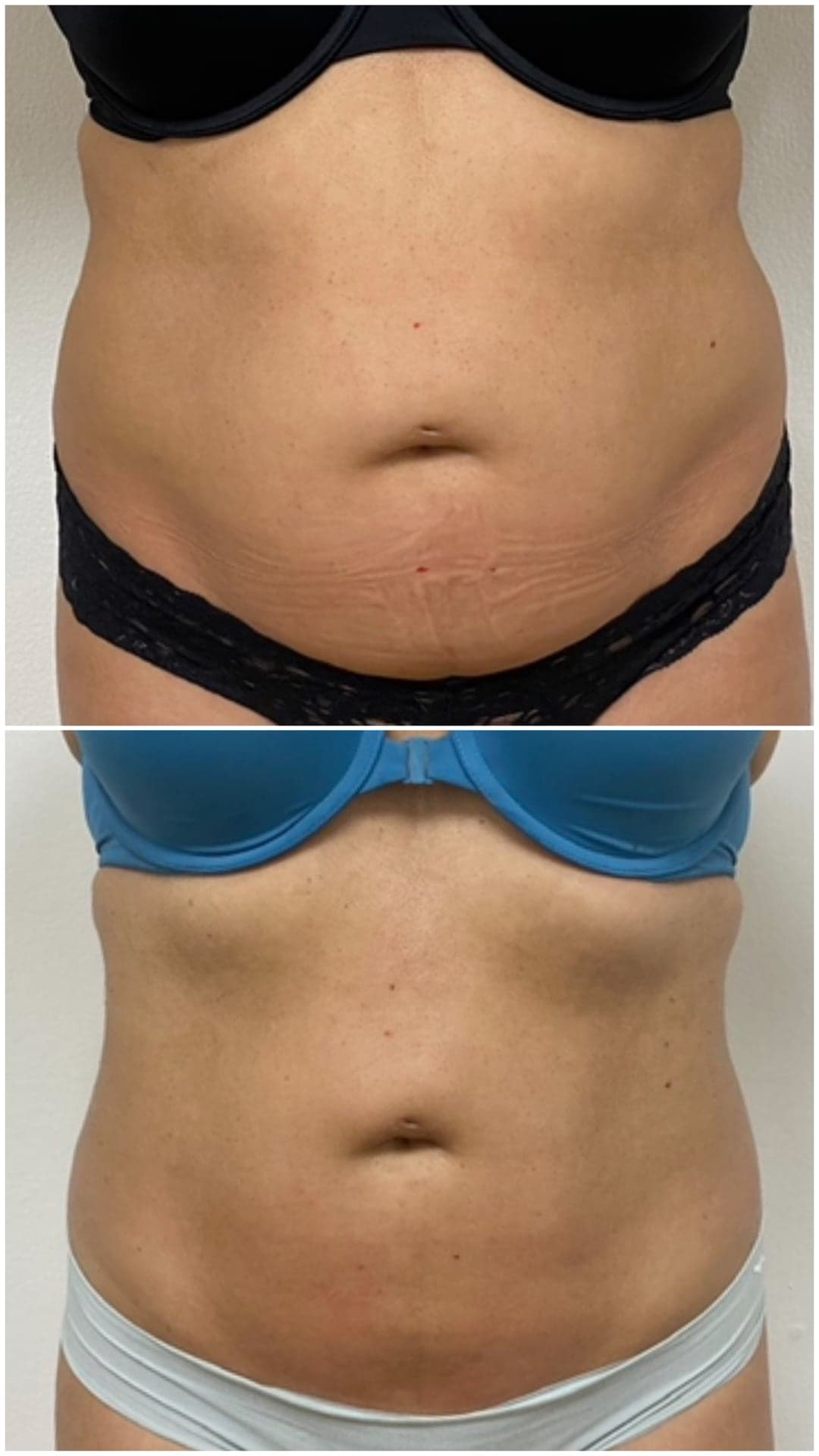 Brazilian Body Bar client before and after result 1