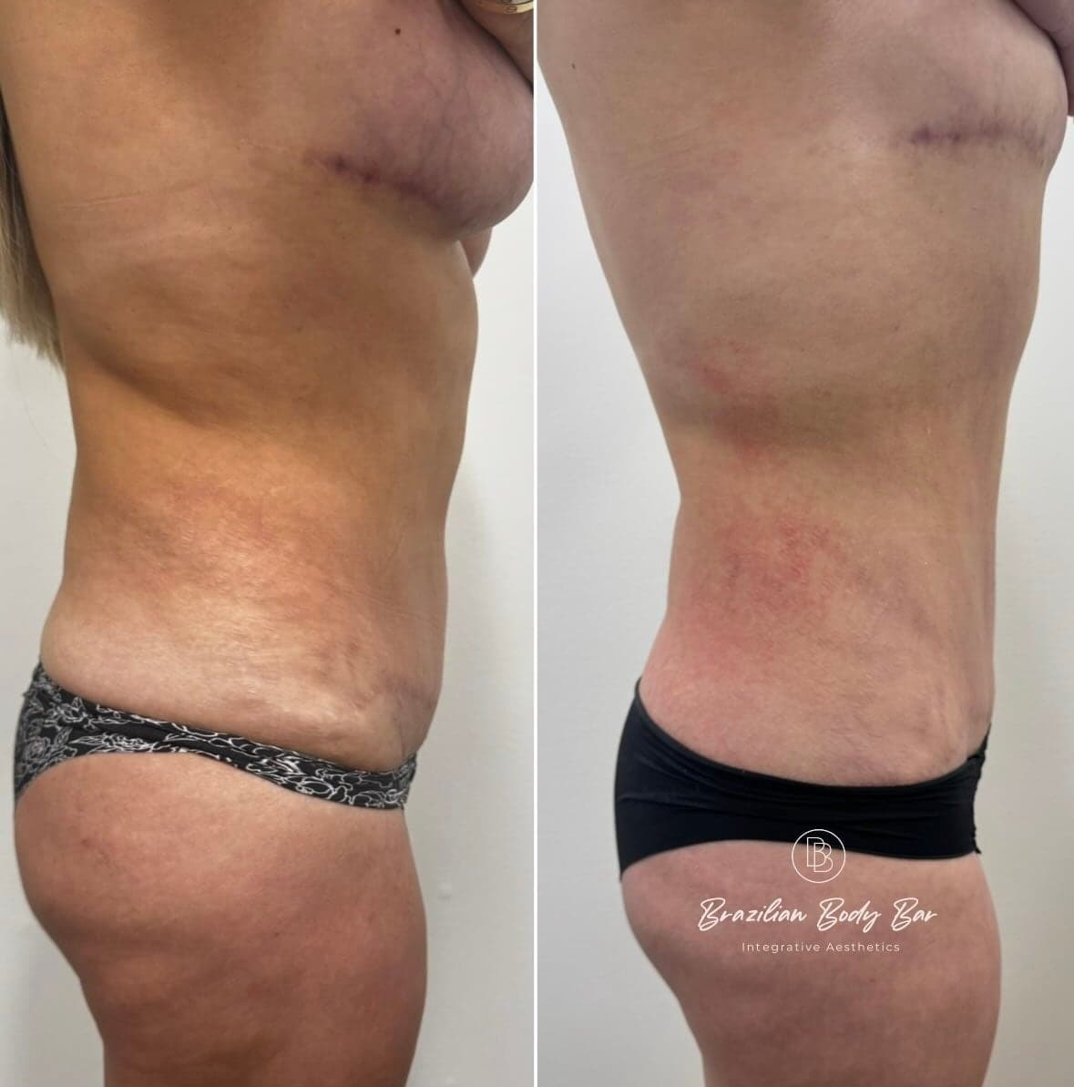 Brazilian Body Bar client before and after result 3