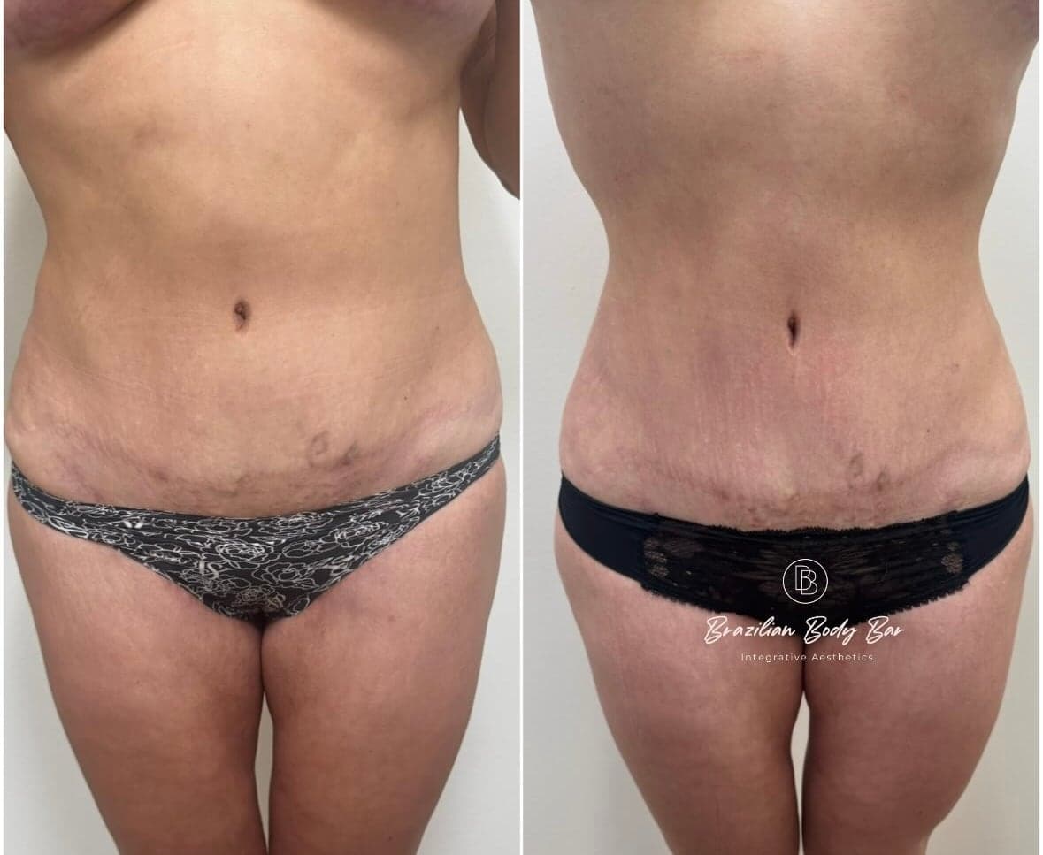 Brazilian Body Bar client before and after result 4
