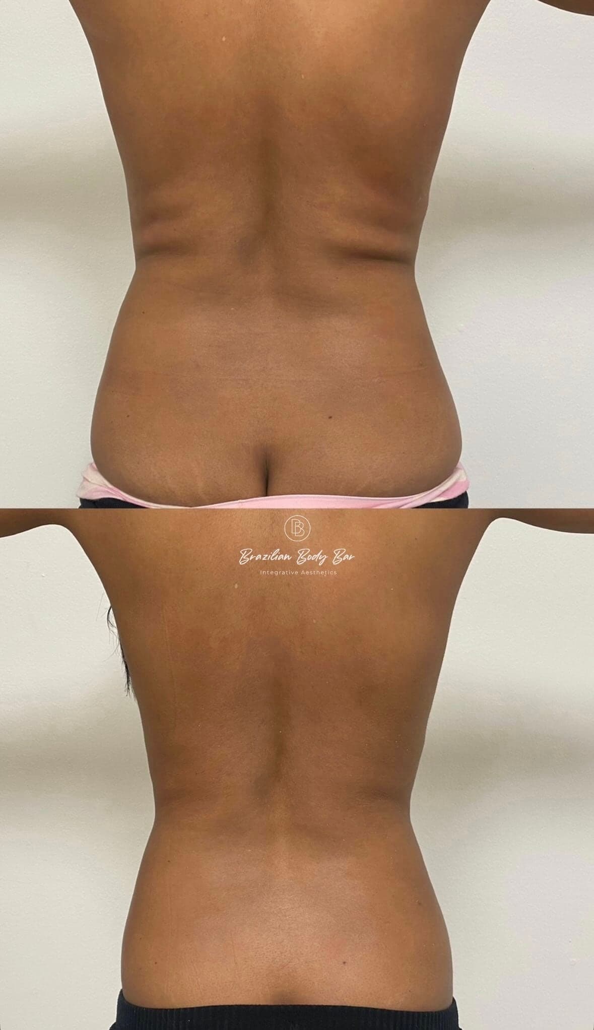 Brazilian Body Bar client before and after result 5