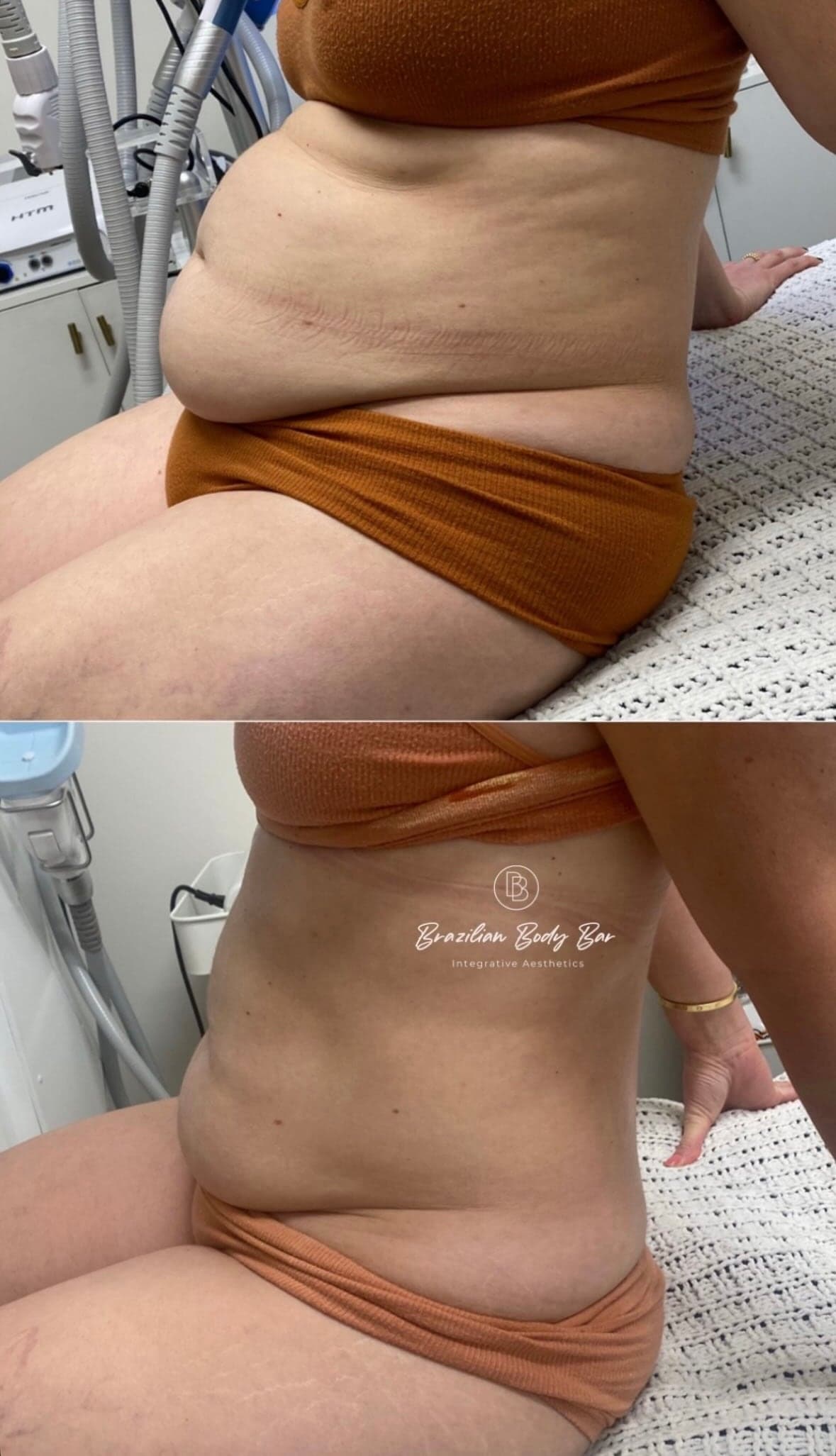 Brazilian Body Bar client before and after result 7