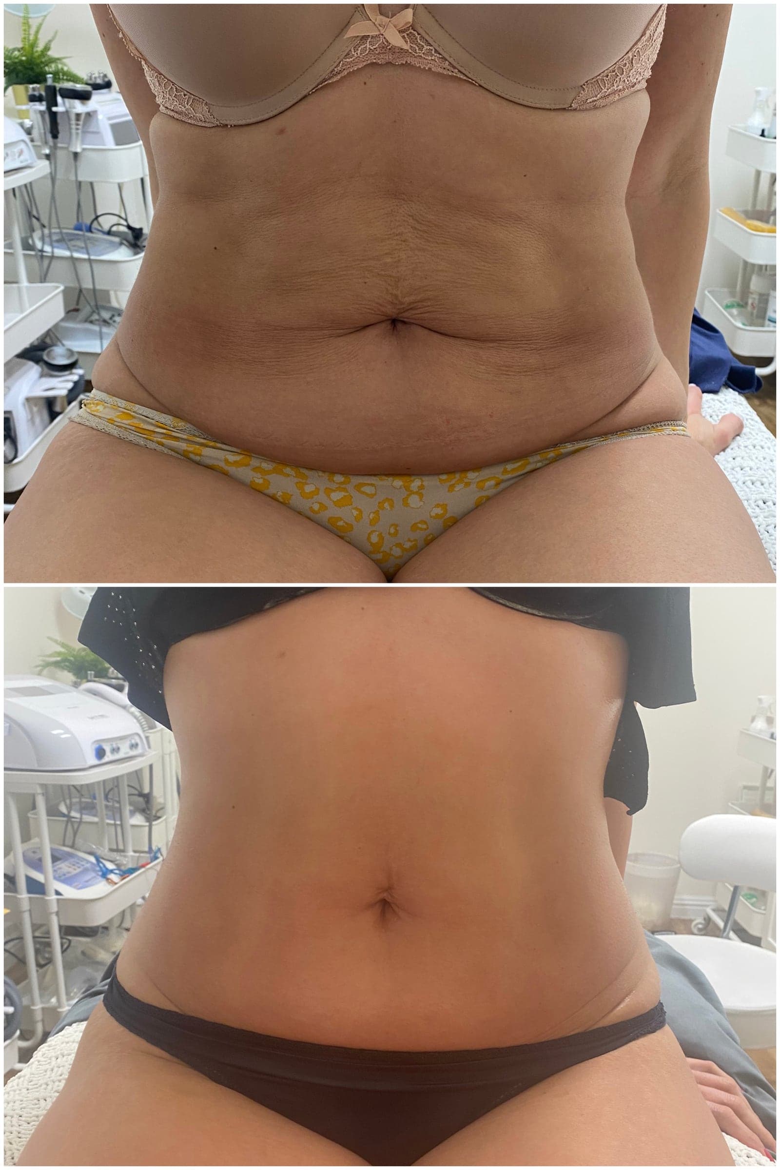 Brazilian Body Bar client before and after result 8