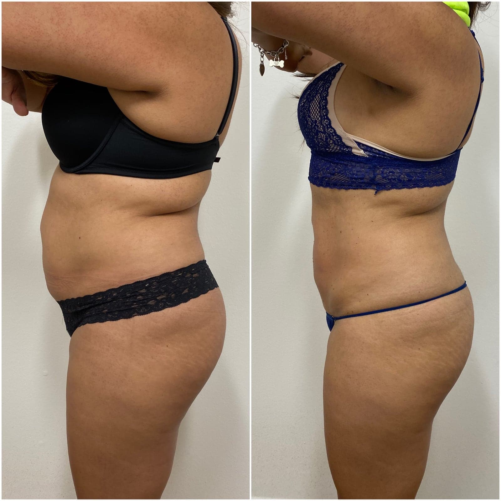 Brazilian Body Bar client before and after result 9