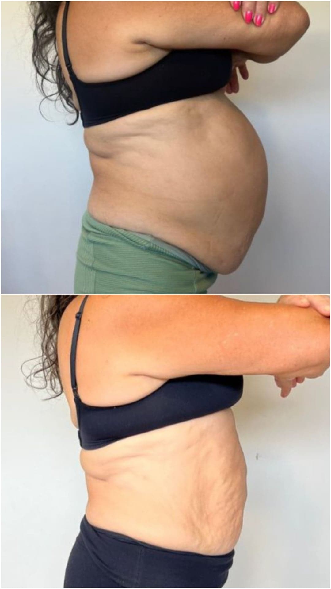 Brazilian Body Bar client before and after result 1