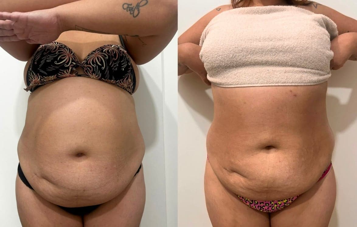 Brazilian Body Bar client before and after result 2