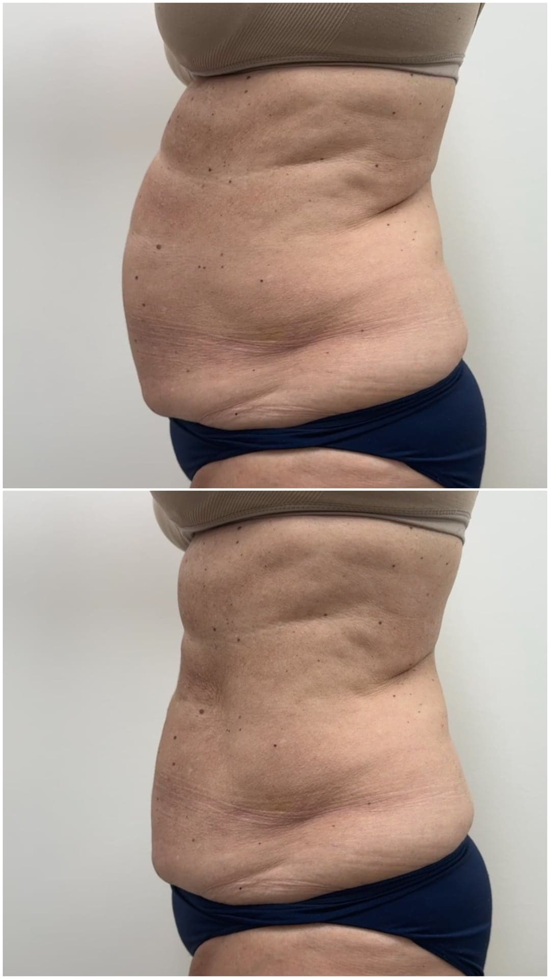 Brazilian Body Bar client before and after result 5