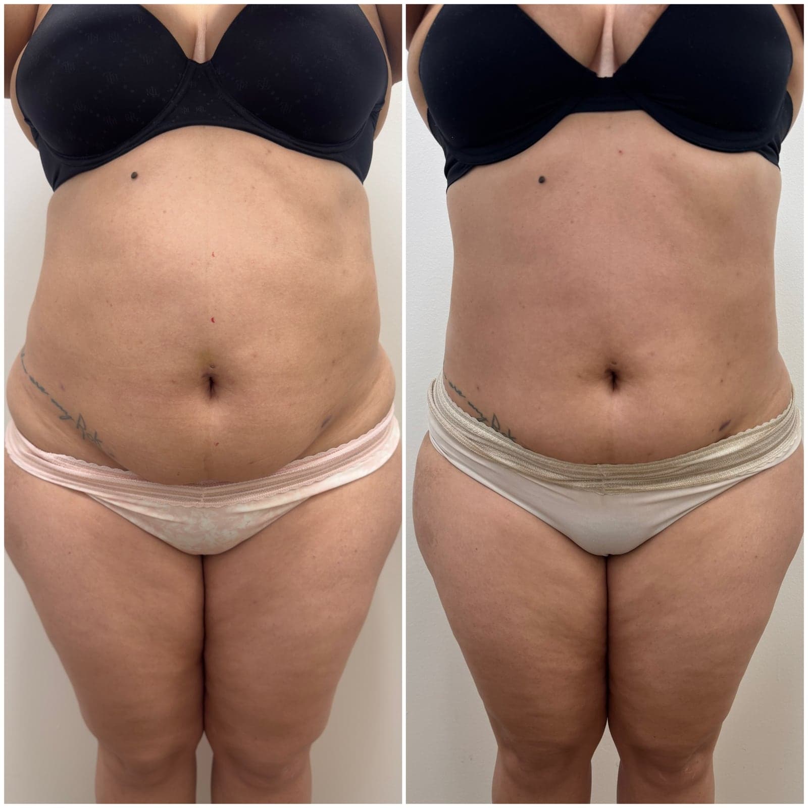 Brazilian Body Bar client before and after result 6