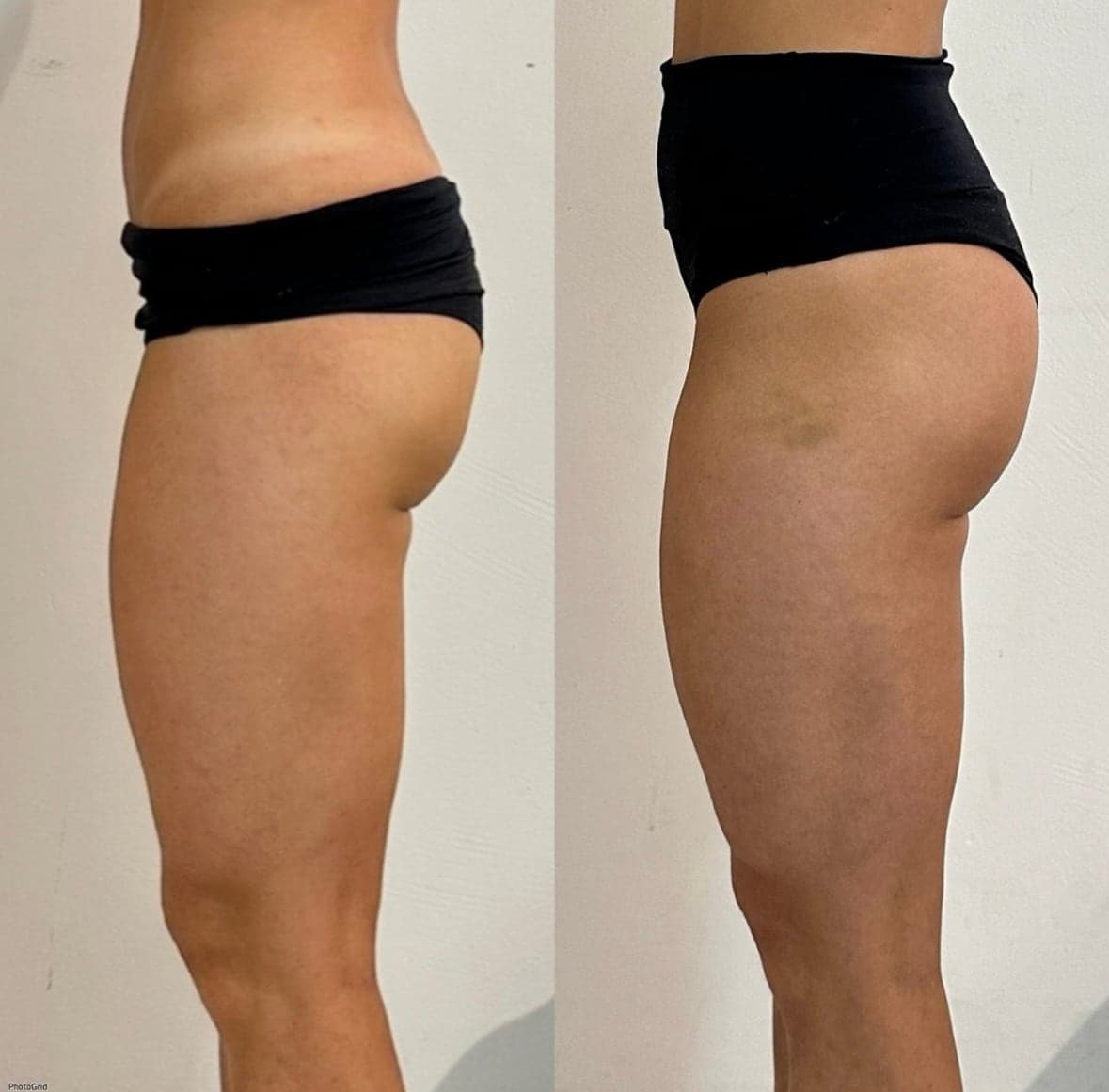 Brazilian Body Bar client before and after result 1