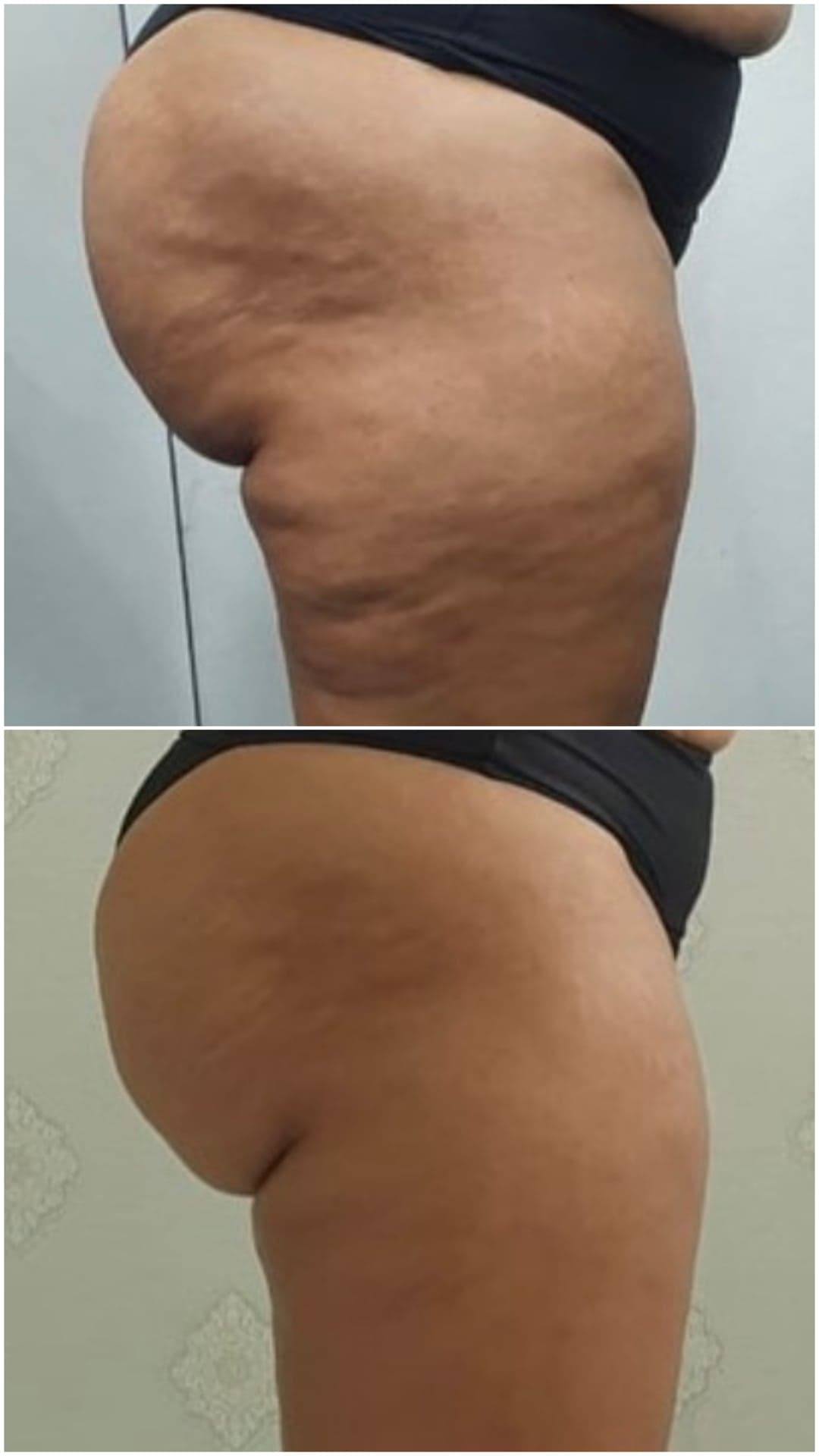 Brazilian Body Bar client before and after result 5