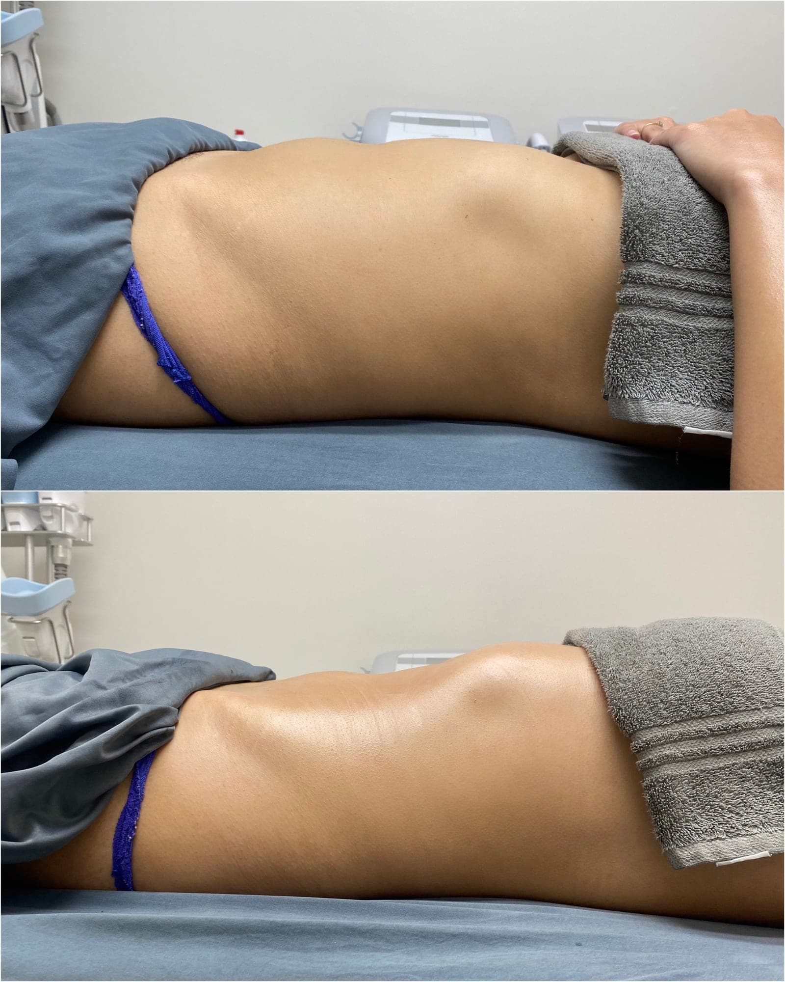 Brazilian Body Bar client before and after result 1