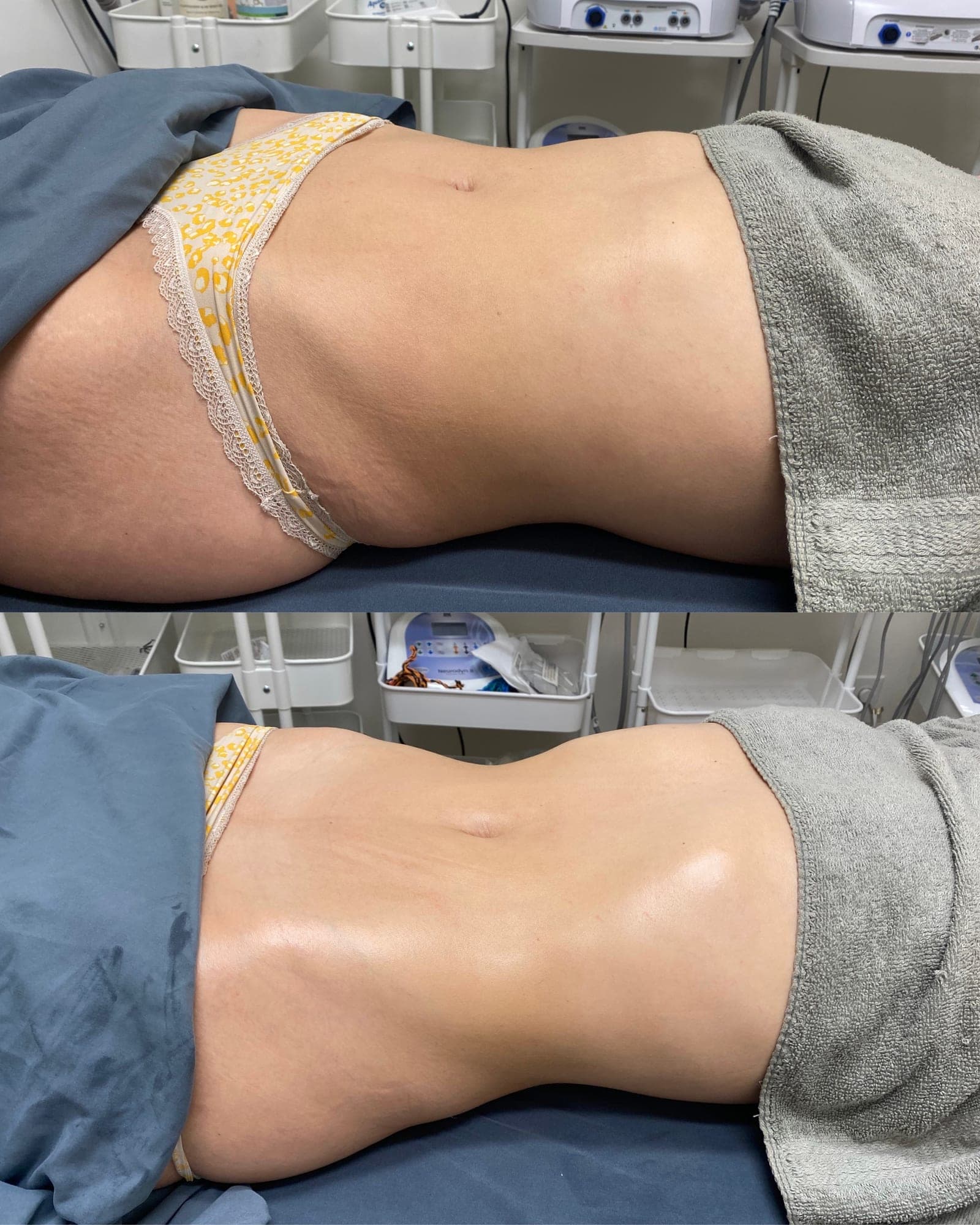 Brazilian Body Bar client before and after result 3