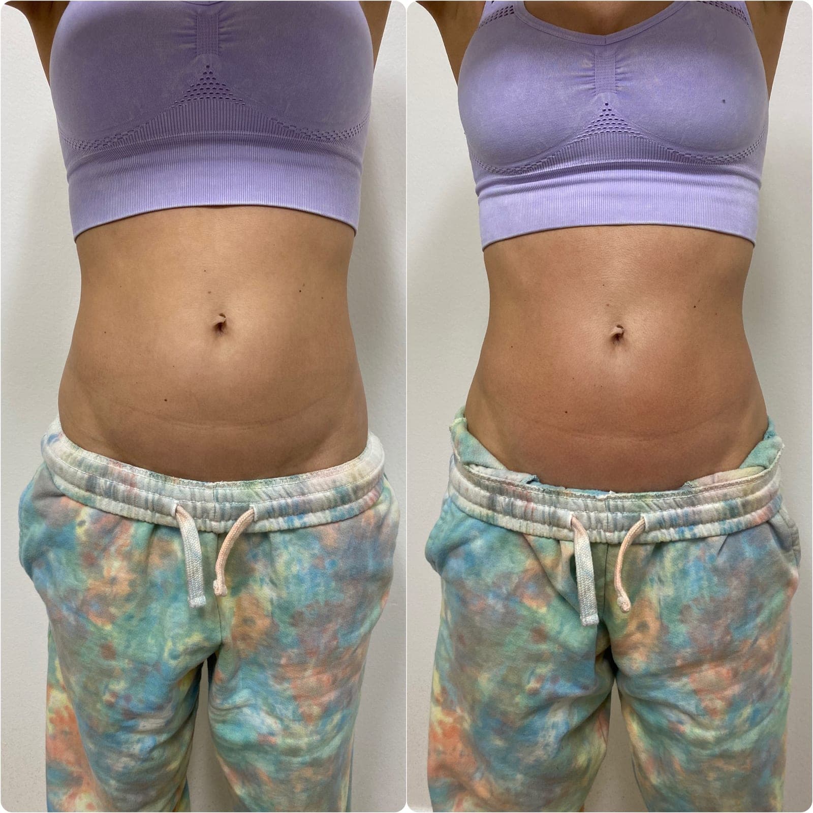 Brazilian Body Bar client before and after result 4