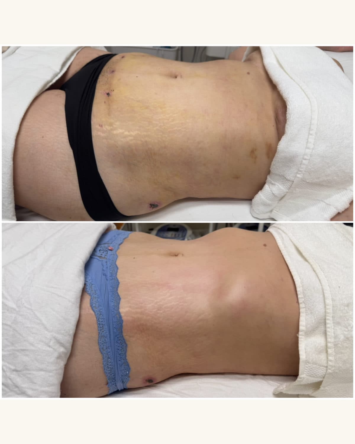 Brazilian Body Bar client before and after result 1