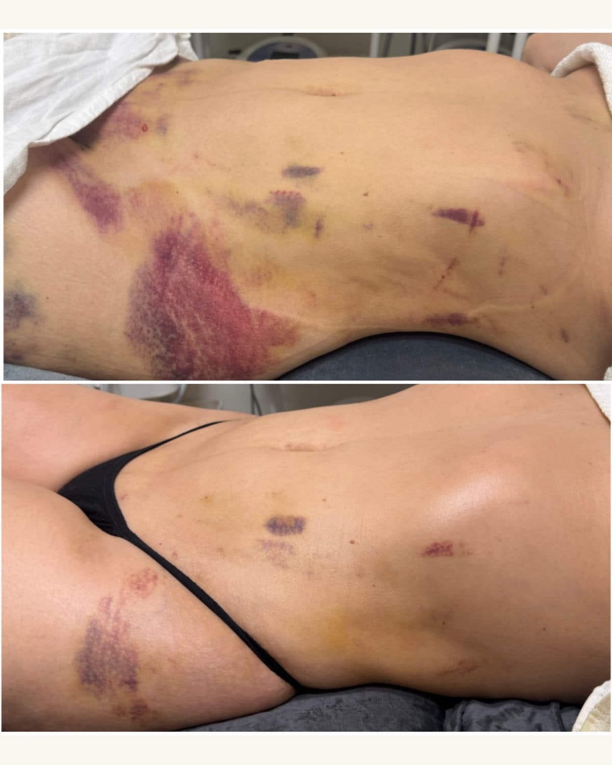 Brazilian Body Bar client before and after result 2