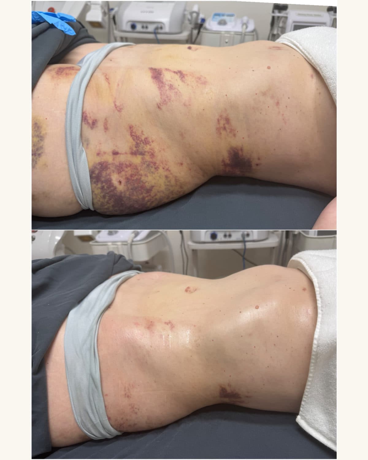 Brazilian Body Bar client before and after result 3