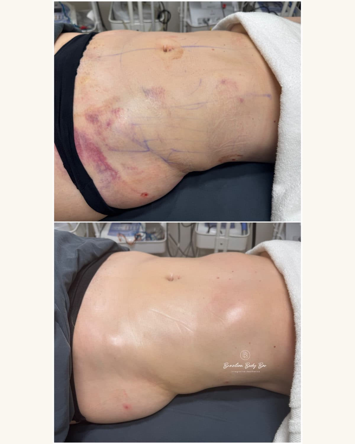 Brazilian Body Bar client before and after result 4