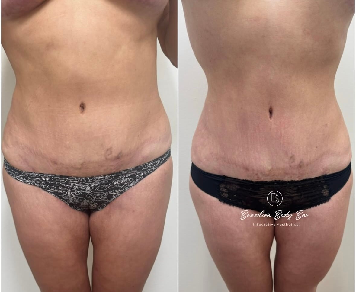 Brazilian Body Bar client before and after result 4