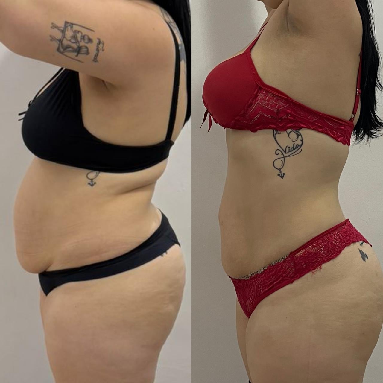 Brazilian Body Bar client before and after result 4