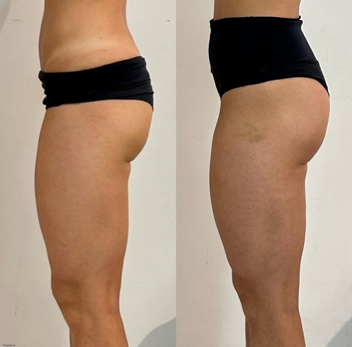 Brazilian Body Bar client before and after result 1