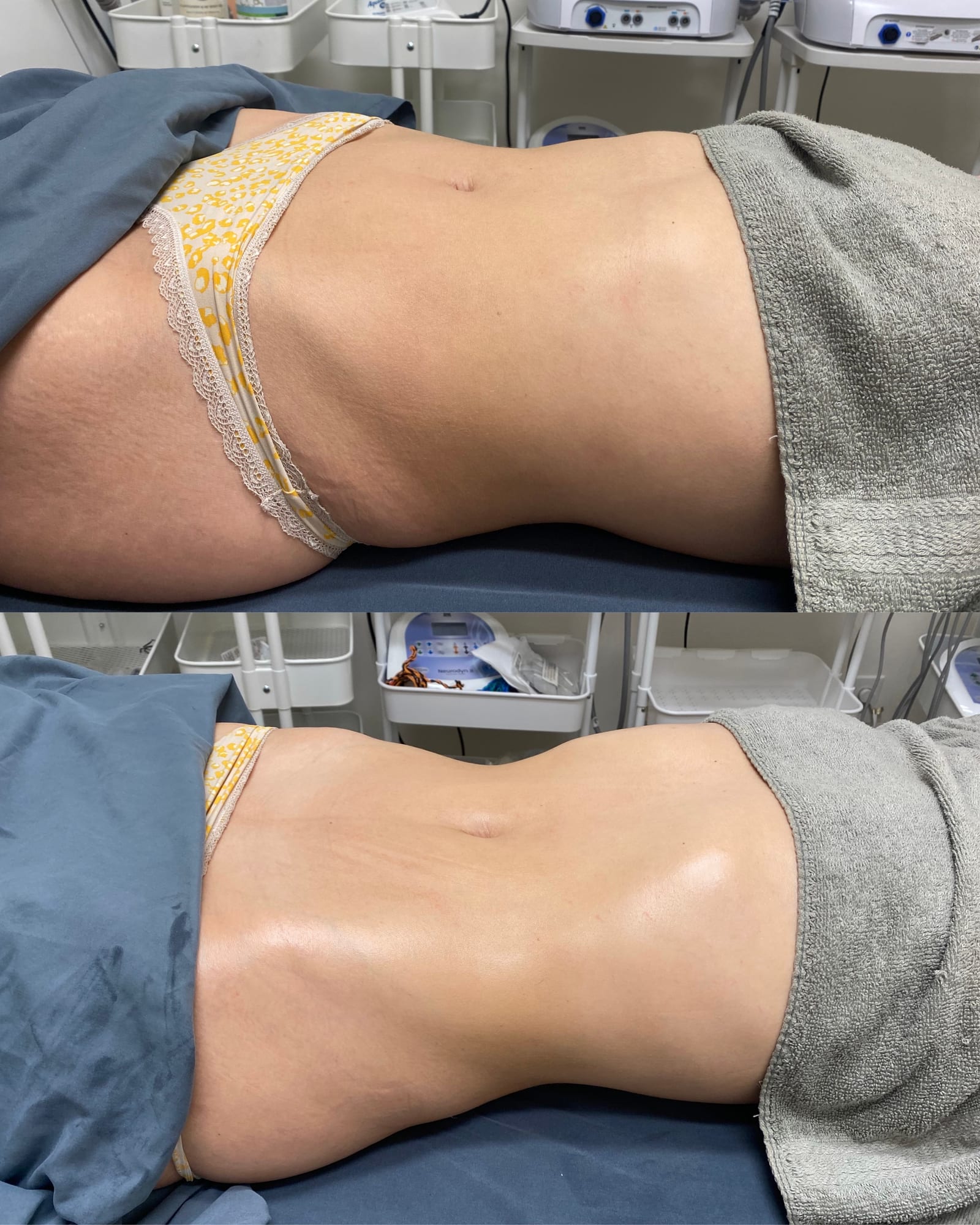 Brazilian Body Bar client before and after result 3