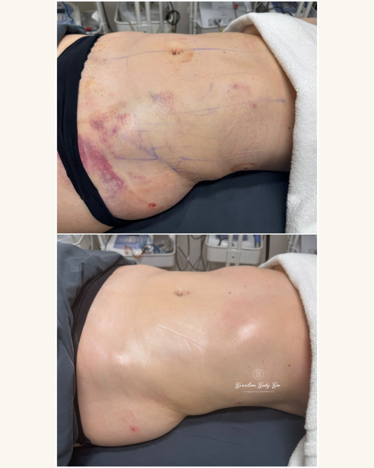 Brazilian Body Bar client before and after result 4